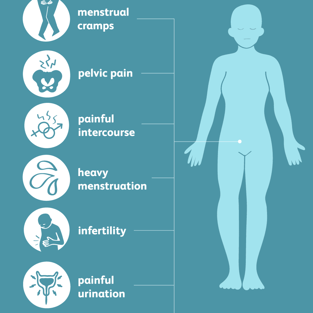 Pelvic Pain Is it ENDOMETRIOSIS