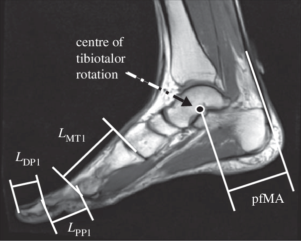 Walk it off Foot and Ankle Musculoskeletal Update for Primary Care